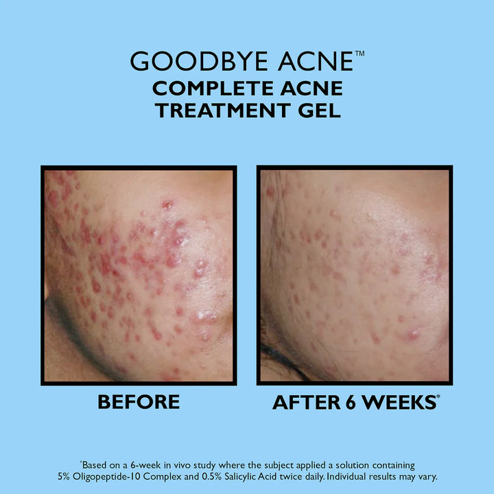 Peter Thomas Roth Goodbye Acne Complete Acne Treatment Gel