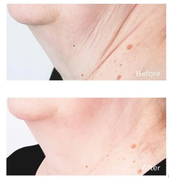Perricone MD Cold Plasma Plus+ Sub-D/ Neck