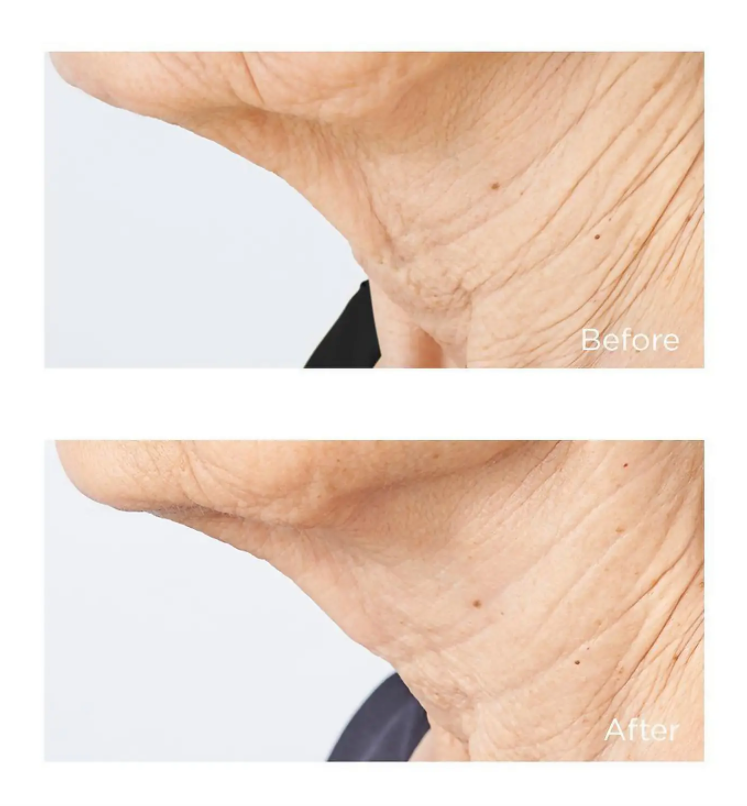 Perricone MD Cold Plasma Plus+ Sub-D/ Neck