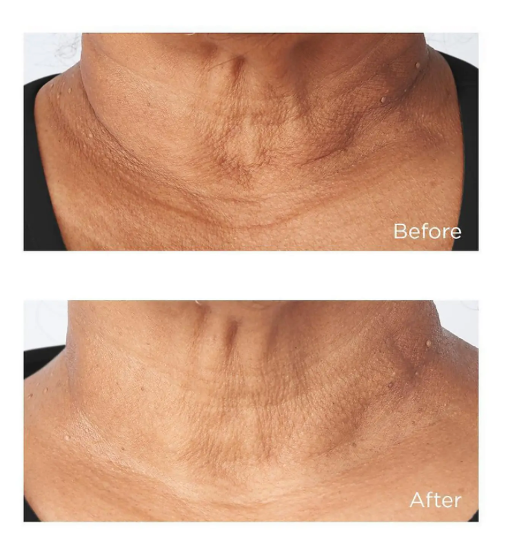 Perricone MD Cold Plasma Plus+ Sub-D/ Neck