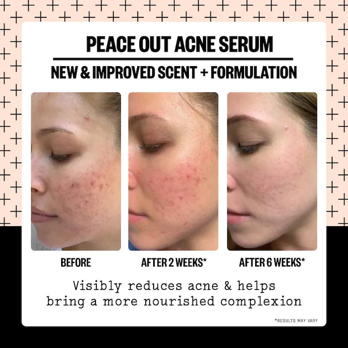 Peace Out Salicylic Acid Acne Treatment Serum
