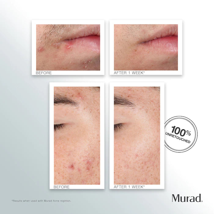 Murad Outsmart Acne Clarifying Treatment