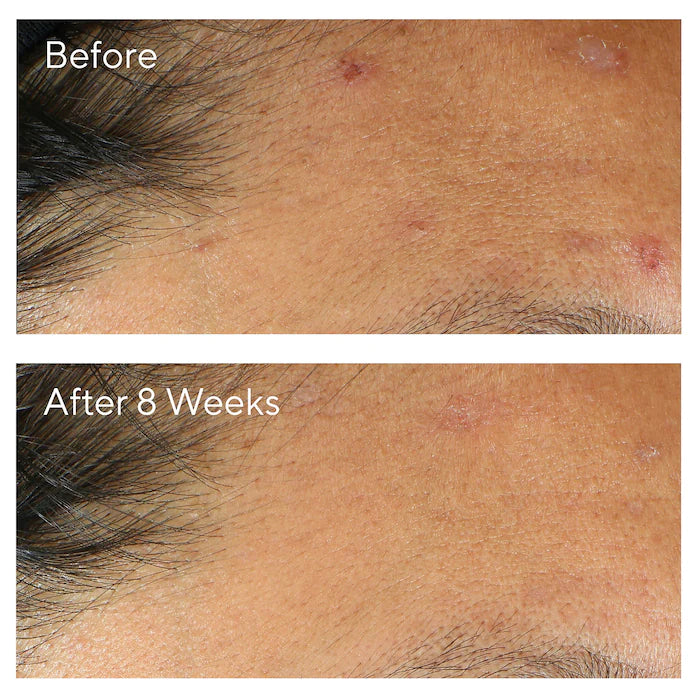 Murad InvisiScar Resurfacing Treatment