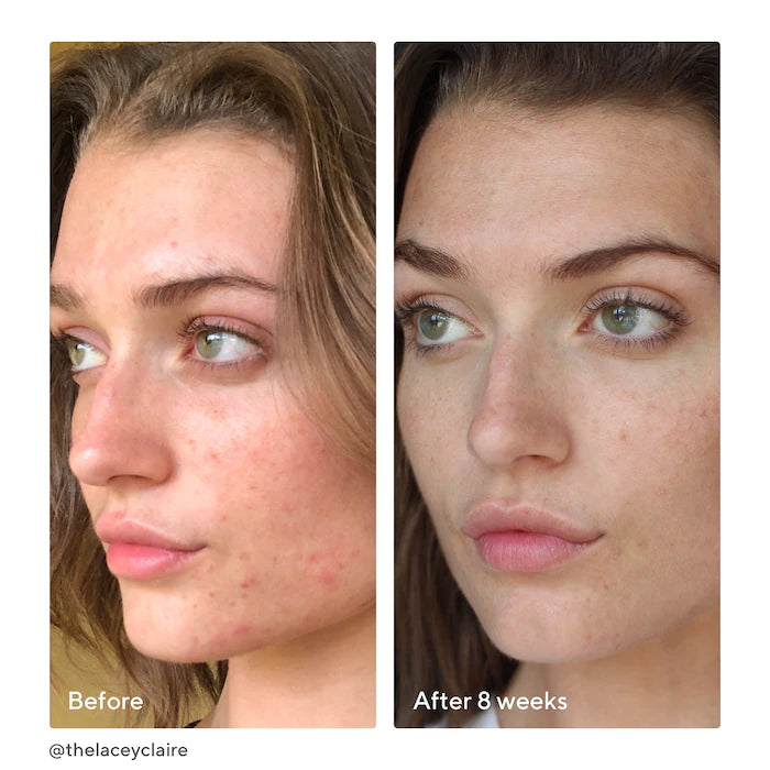 Murad InvisiScar Resurfacing Treatment