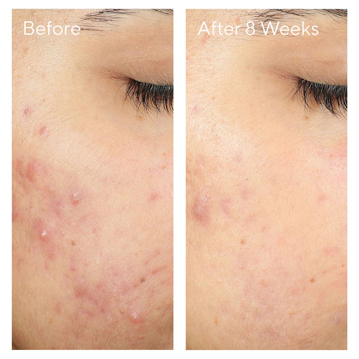 Murad InvisiScar Resurfacing Treatment